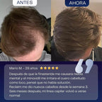Suero para el Crecimiento del Cabello